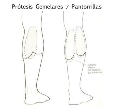 Prótesis de Pantorrillas