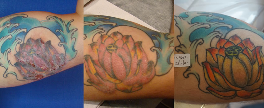 picoPlus... la solucin tambin para los tatuajes que generan alergias.