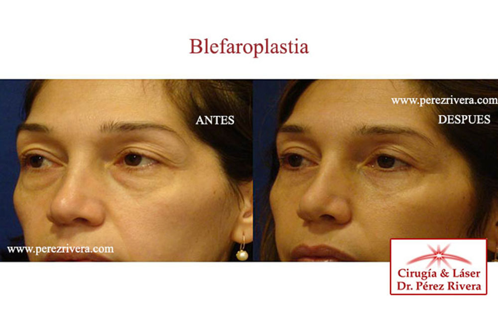 Antes y Despues